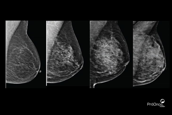 Classificação BI-RADS: o que significa cada categoria?
